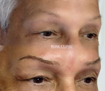 Best cosmetic tattoo clinic in perth - rose clinic